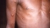 La dermatología de la viruela y cómo evitar sus cicatrices