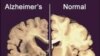 Study: Exercise Lowers Risk of Dementia