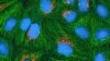 To Gauge Prostate Cancer Risk, Explore More Family Ties