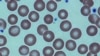 Bone Marrow Transplants Scarce in Many Countries